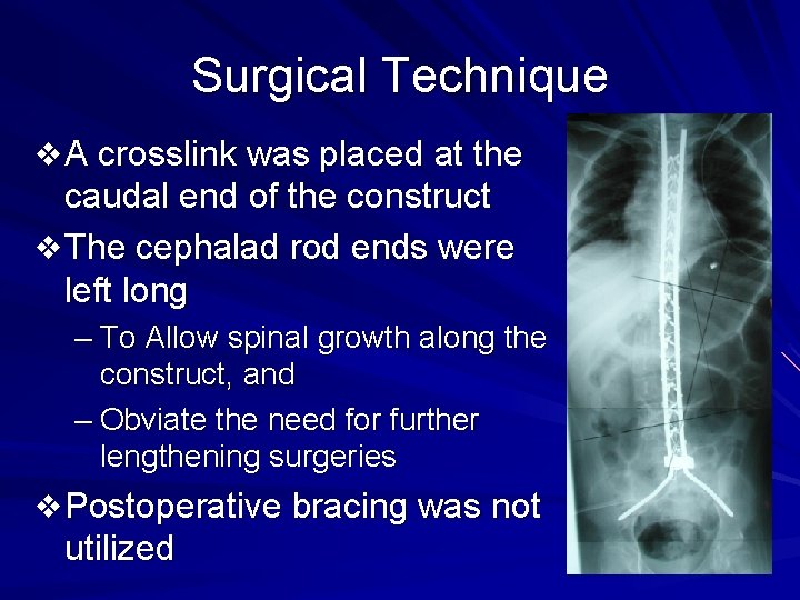Surgical Technique v A crosslink was placed at the caudal end of the construct