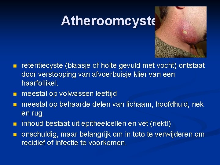 Atheroomcyste n n n retentiecyste (blaasje of holte gevuld met vocht) ontstaat door verstopping