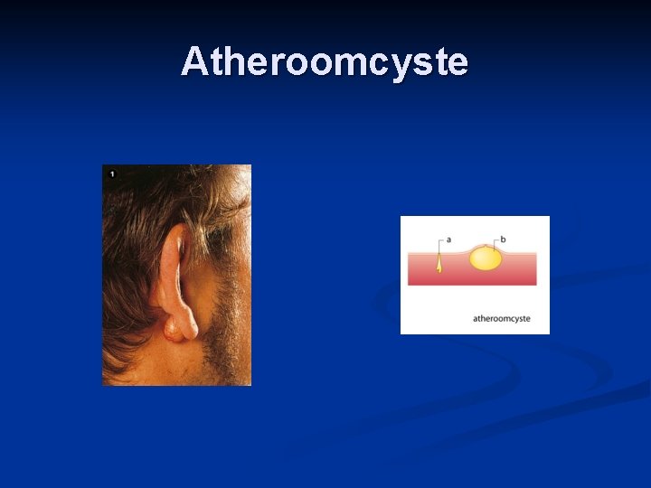 Atheroomcyste 