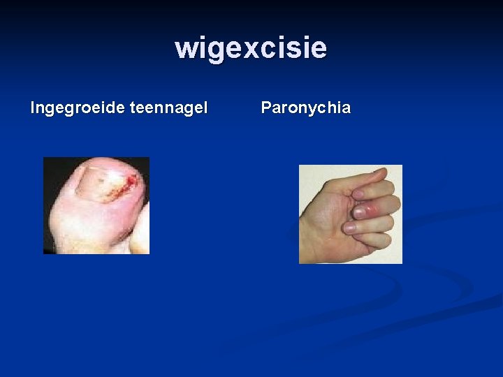 wigexcisie Ingegroeide teennagel Paronychia 