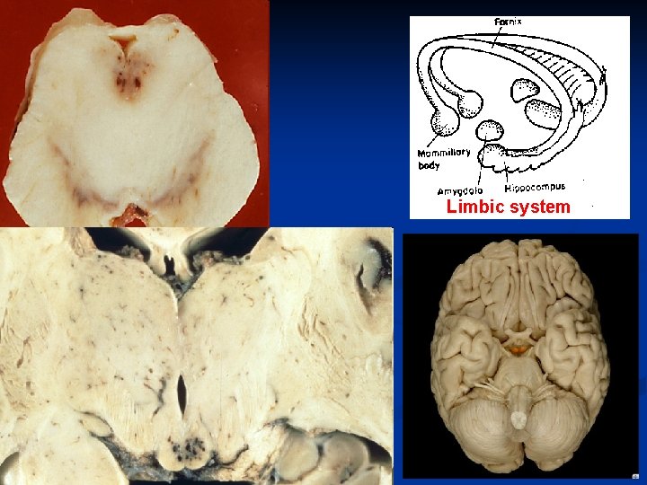 Limbic system 