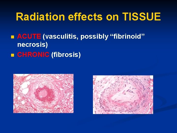 Radiation effects on TISSUE n n ACUTE (vasculitis, possibly “fibrinoid” necrosis) CHRONIC (fibrosis) 