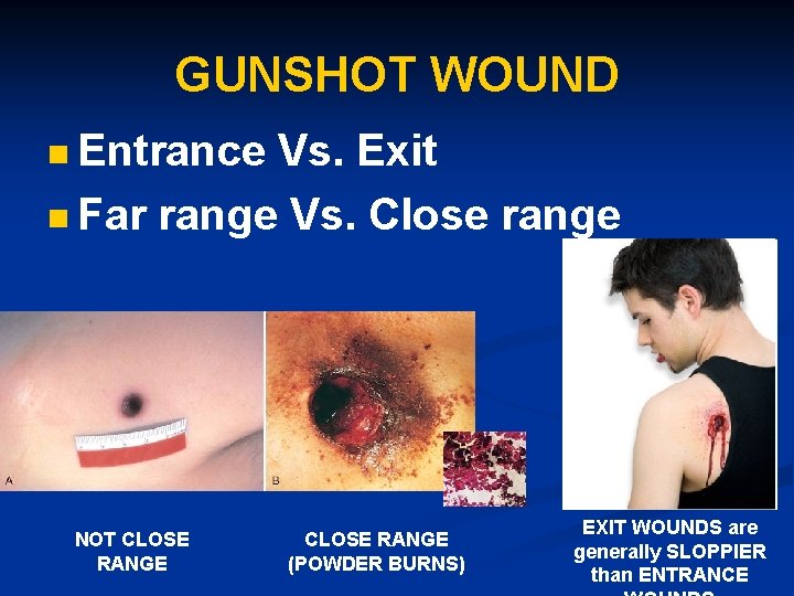 GUNSHOT WOUND n Entrance Vs. Exit n Far range Vs. Close range NOT CLOSE