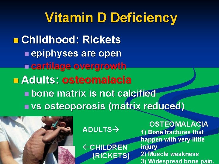 Vitamin D Deficiency n Childhood: Rickets n epiphyses are open n cartilage overgrowth n