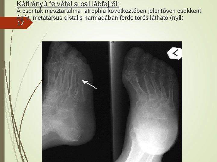 Kétirányú felvétel a bal lábfejről: A csontok mésztartalma, atrophia következtében jelentősen csökkent. Az V.