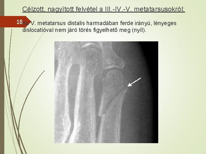 Célzott, nagyított felvétel a III. -IV. -V. metatarsusokról: 18 Az V. metatarsus distalis harmadában