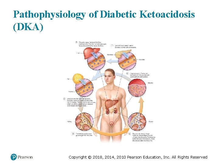 Pathophysiology of Diabetic Ketoacidosis (DKA) Copyright © 2018, 2014, 2010 Pearson Education, Inc. All