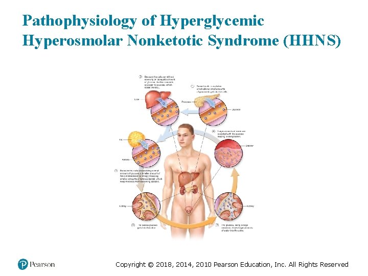 Pathophysiology of Hyperglycemic Hyperosmolar Nonketotic Syndrome (HHNS) Copyright © 2018, 2014, 2010 Pearson Education,