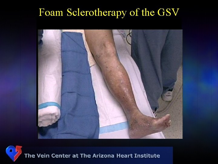 Foam Sclerotherapy of the GSV 