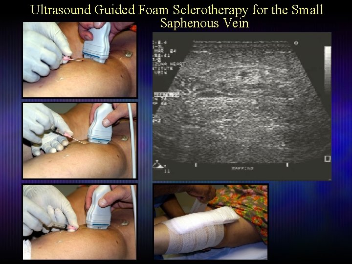 Ultrasound Guided Foam Sclerotherapy for the Small Saphenous Vein 