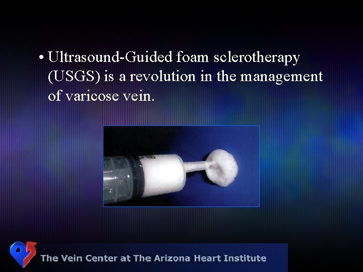  • Ultrasound-Guided foam sclerotherapy (USGS) is a revolution in the management of varicose
