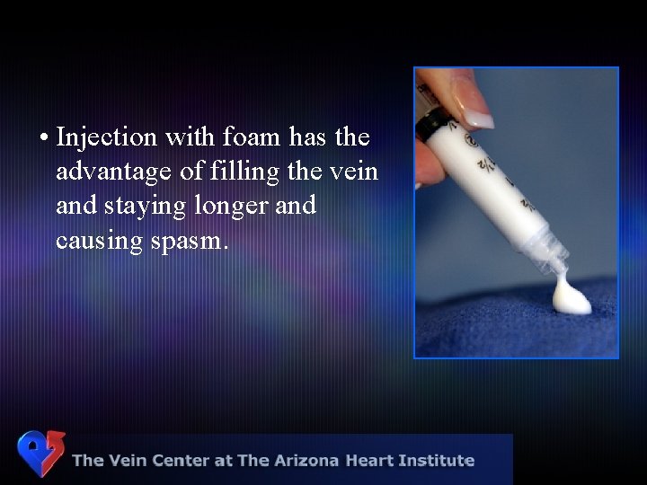  • Injection with foam has the advantage of filling the vein and staying