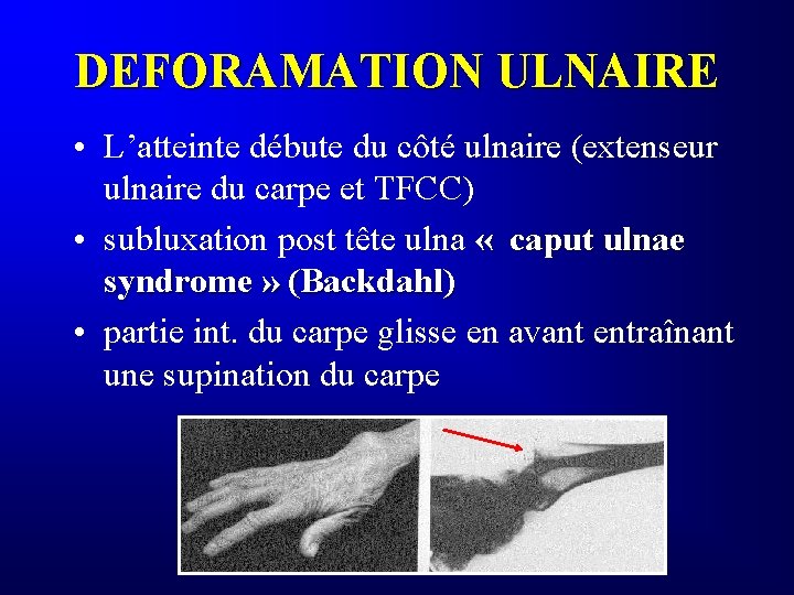 DEFORAMATION ULNAIRE • L’atteinte débute du côté ulnaire (extenseur ulnaire du carpe et TFCC)