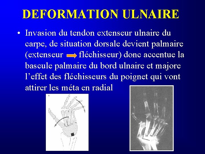 DEFORMATION ULNAIRE • Invasion du tendon extenseur ulnaire du carpe, de situation dorsale devient