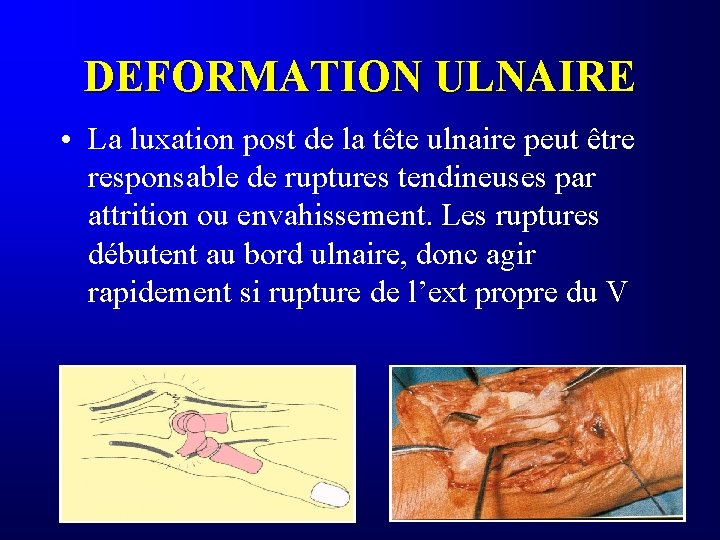 DEFORMATION ULNAIRE • La luxation post de la tête ulnaire peut être responsable de