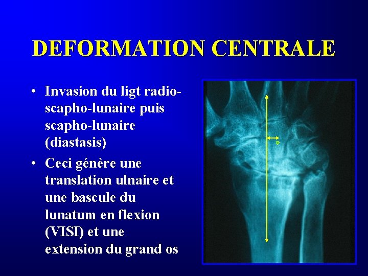 DEFORMATION CENTRALE • Invasion du ligt radioscapho-lunaire puis scapho-lunaire (diastasis) • Ceci génère une