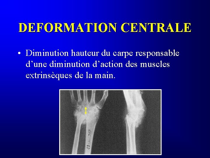 DEFORMATION CENTRALE • Diminution hauteur du carpe responsable d’une diminution d’action des muscles extrinsèques