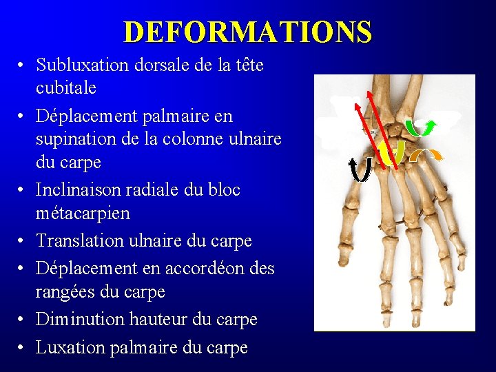 DEFORMATIONS • Subluxation dorsale de la tête cubitale • Déplacement palmaire en supination de