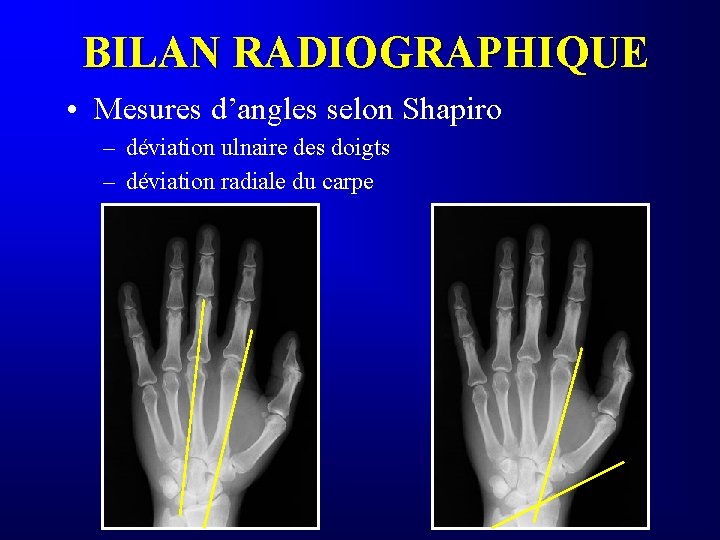 BILAN RADIOGRAPHIQUE • Mesures d’angles selon Shapiro – déviation ulnaire des doigts – déviation