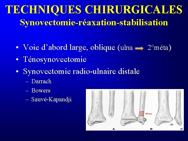 TECHNIQUES CHIRURGICALES Synovectomie-réaxation-stabilisation • Voie d’abord large, oblique (ulna 2°méta) • Ténosynovectomie • Synovectomie