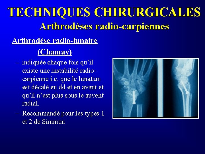 TECHNIQUES CHIRURGICALES Arthrodèses radio-carpiennes Arthrodèse radio-lunaire (Chamay) – indiquée chaque fois qu’il existe une