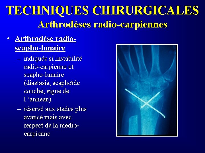 TECHNIQUES CHIRURGICALES Arthrodèses radio-carpiennes • Arthrodèse radioscapho-lunaire – indiquée si instabilité radio-carpienne et scapho-lunaire
