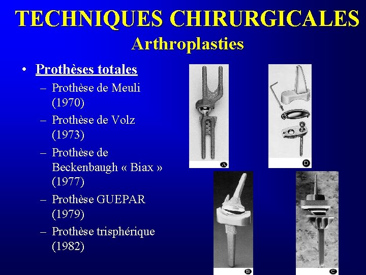 TECHNIQUES CHIRURGICALES Arthroplasties • Prothèses totales – Prothèse de Meuli (1970) – Prothèse de
