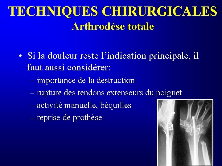 TECHNIQUES CHIRURGICALES Arthrodèse totale • Si la douleur reste l’indication principale, il faut aussi