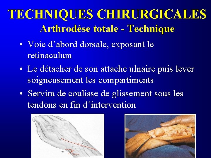 TECHNIQUES CHIRURGICALES Arthrodèse totale - Technique • Voie d’abord dorsale, exposant le retinaculum •