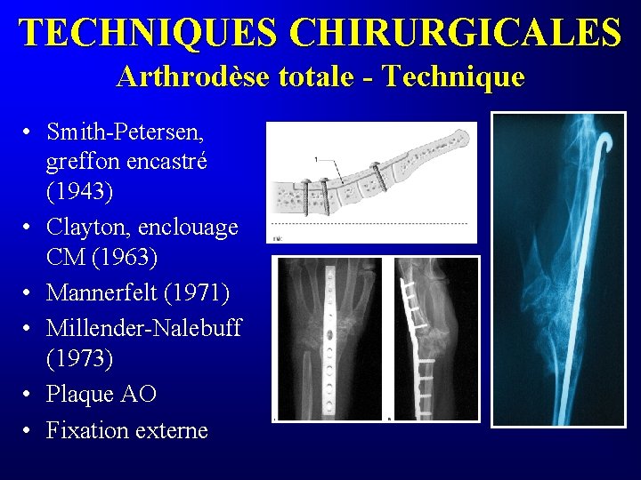 TECHNIQUES CHIRURGICALES Arthrodèse totale - Technique • Smith-Petersen, greffon encastré (1943) • Clayton, enclouage