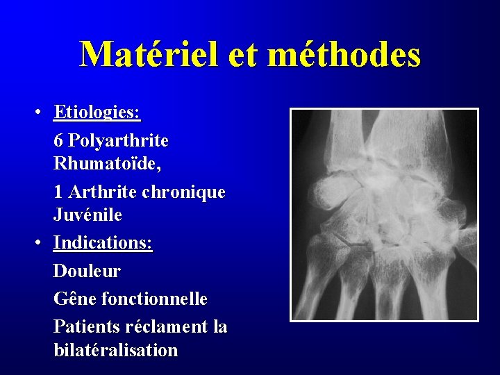 Matériel et méthodes • Etiologies: 6 Polyarthrite Rhumatoïde, 1 Arthrite chronique Juvénile • Indications: