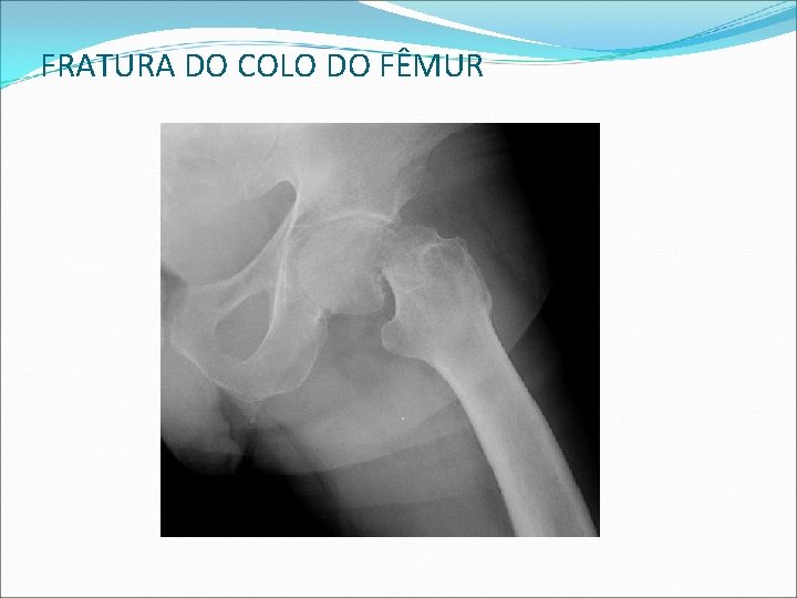 FRATURA DO COLO DO FÊMUR FRATURA DO COLO DO FÊMUR