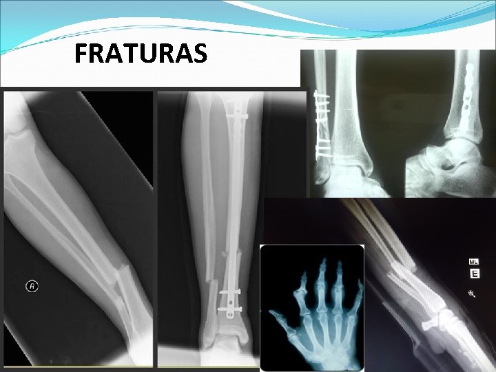 FRATURAS FRATURAS