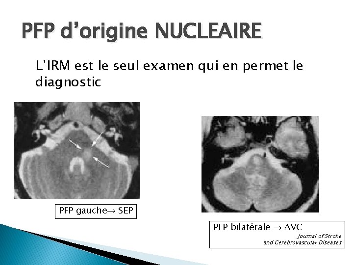 PFP d’origine NUCLEAIRE L’IRM est le seul examen qui en permet le diagnostic PFP