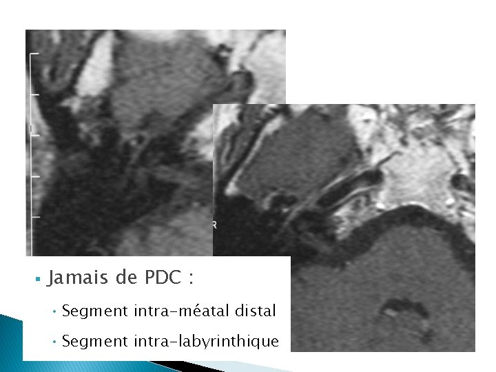 § Jamais de PDC : • Segment intra-méatal distal • Segment intra-labyrinthique 