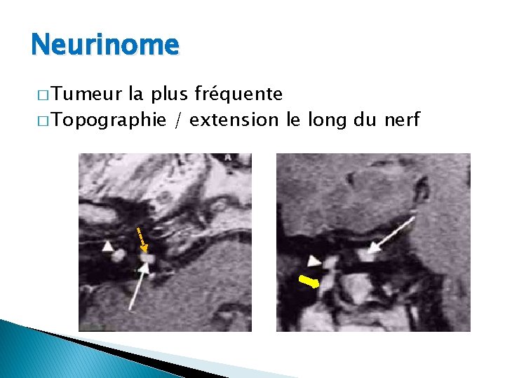 Neurinome � Tumeur la plus fréquente � Topographie / extension le long du nerf