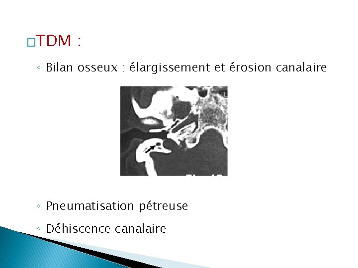 �TDM : ◦ Bilan osseux : élargissement et érosion canalaire ◦ Pneumatisation pétreuse ◦