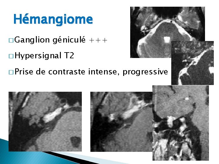 Hémangiome � Ganglion géniculé +++ � Hypersignal � Prise T 2 de contraste intense,