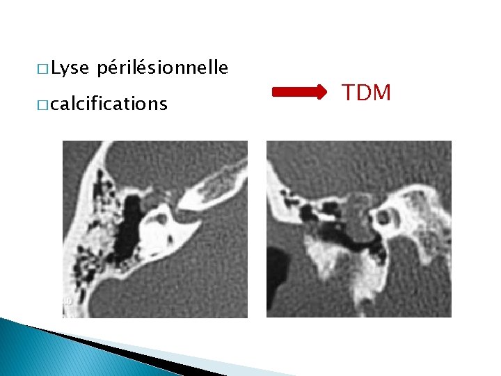 � Lyse périlésionnelle � calcifications TDM 