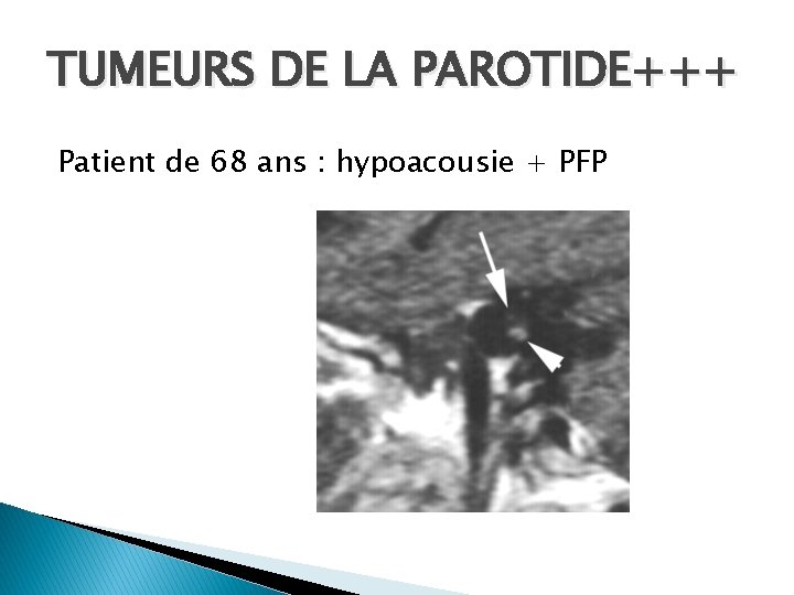 TUMEURS DE LA PAROTIDE+++ Patient de 68 ans : hypoacousie + PFP 