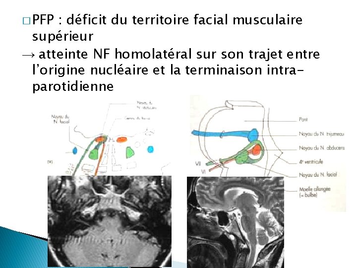 � PFP : déficit du territoire facial musculaire supérieur → atteinte NF homolatéral sur