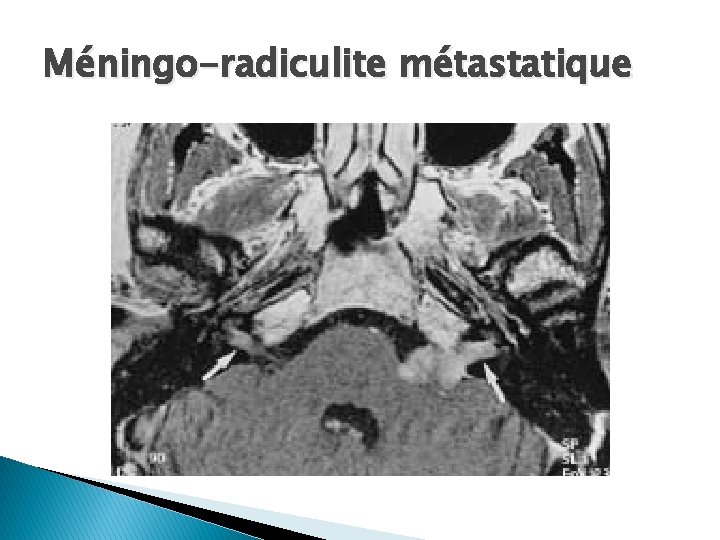 Méningo-radiculite métastatique 