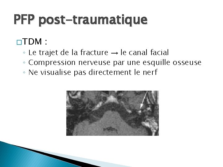 PFP post-traumatique � TDM : ◦ Le trajet de la fracture → le canal