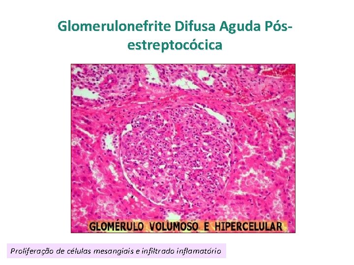 Glomerulonefrite Difusa Aguda Pósestreptocócica Proliferação de células mesangiais e infiltrado inflamatório 