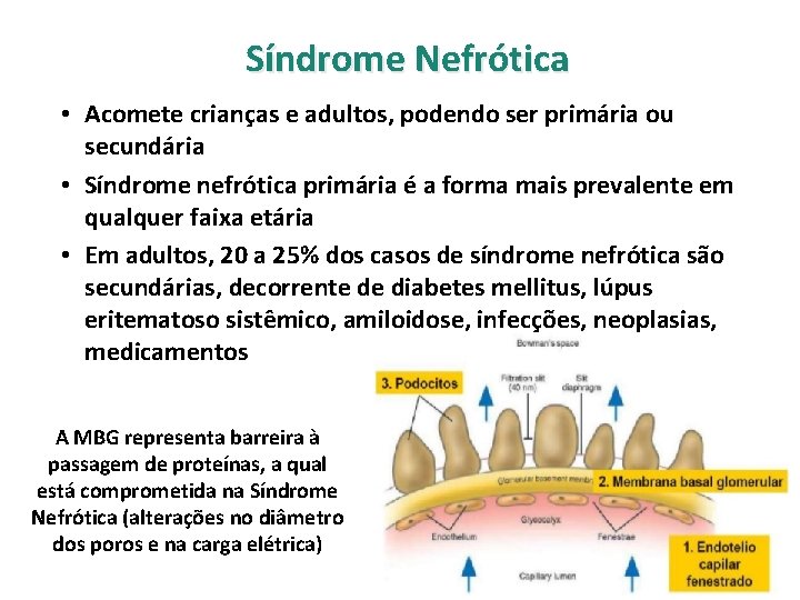 Síndrome Nefrótica • Acomete crianças e adultos, podendo ser primária ou secundária • Síndrome