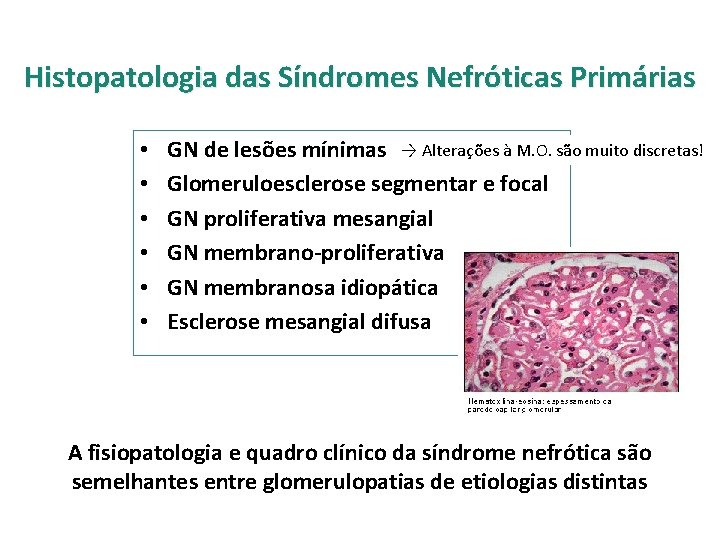 Histopatologia das Síndromes Nefróticas Primárias • • • GN de lesões mínimas → Alterações