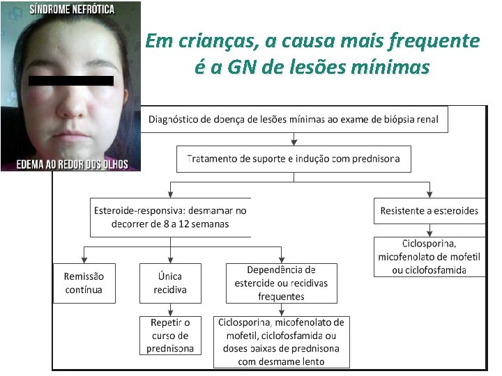 Em crianças, a causa mais frequente é a GN de lesões mínimas 