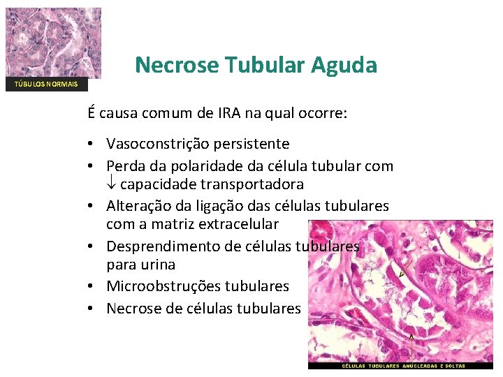 Necrose Tubular Aguda TÚBULOS NORMAIS É causa comum de IRA na qual ocorre: •