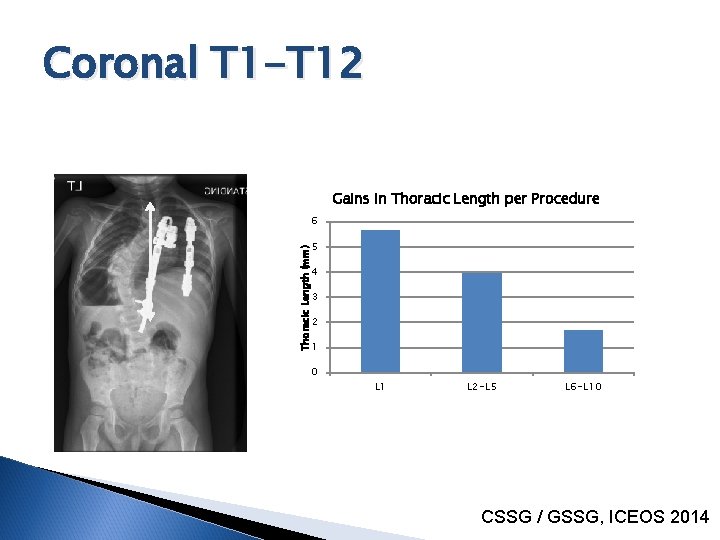 Coronal T 1 -T 12 Gains in Thoracic Length per Procedure 6 Thoracic Length