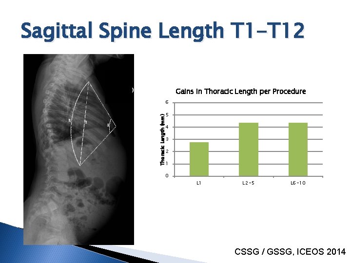 Sagittal Spine Length T 1 -T 12 Gains in Thoracic Length per Procedure 6